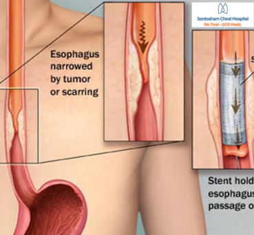 <p>Personalized Esophageal Surgery: What Patients Should Know</p>
